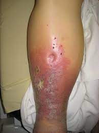 Picture of Vascular disease