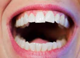 Picture of Open Mouth Teeth showing